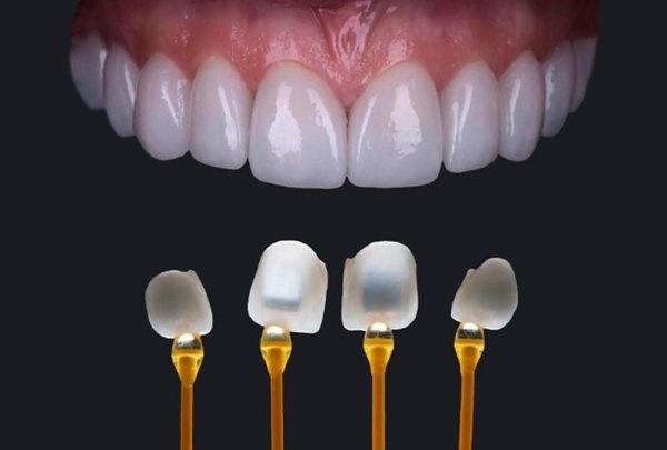 Răng sứ Emax