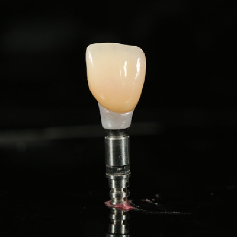 Phục hình trên Implant